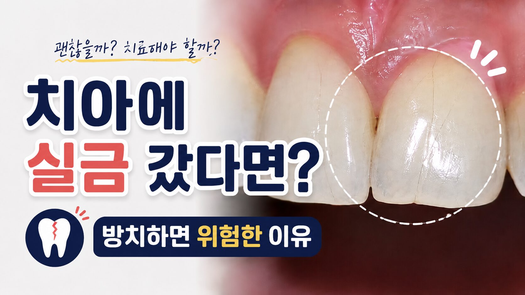 치아 실금 갔을때